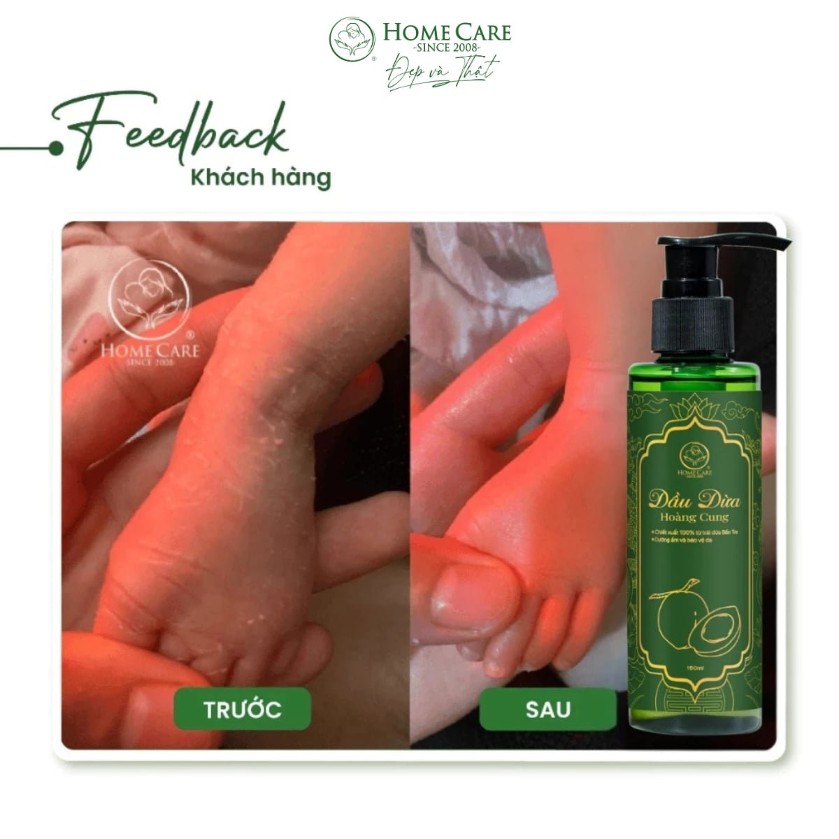 Dầu Massage Giảm Rạn Da Cho Mẹ Bầu Chiết Xuất Từ Dừa